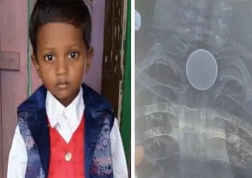 सिक्के निगलने से 8 साल के मासूम की मौत, जिला अस्पताल पर लापरवाही का आरोप