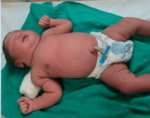 बस्तर के ‘मेकाॅज’ में अनोखा मामला: ओडिशा की महिला ने दिया 5.09 किलो के ‘सुपर बेबी’ को जन्म, डॉक्टरों की टीम हैरान