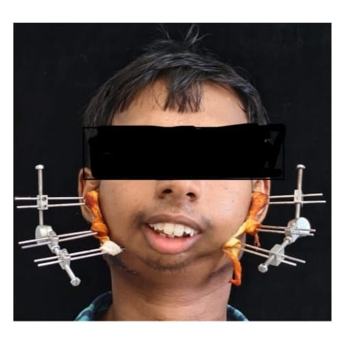 बिलासपुर सिम्स में मेडिकल चमत्कार: 24 वर्षीय युवक का बचपन से बंद जबड़ा जटिल सर्जरी से खुला, आयुष्मान से मिला नया जीवन